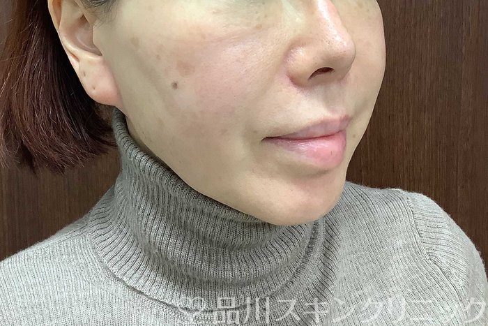 症例NO.71291のBEFORE写真