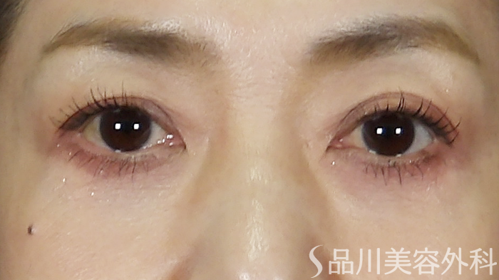 症例NO.69814のAFTER写真