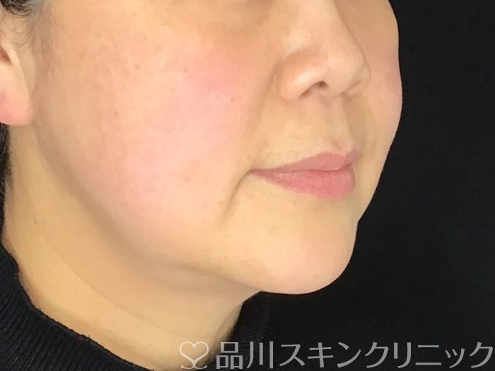 症例NO.68651のBEFORE写真