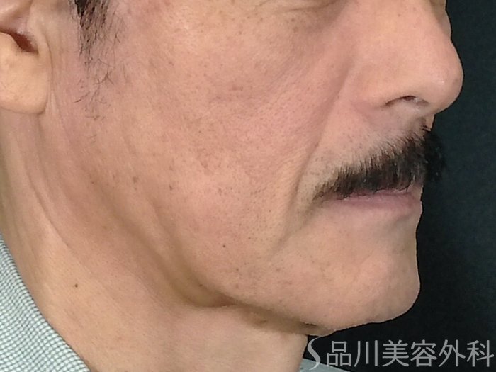 症例NO.70697のBEFORE写真