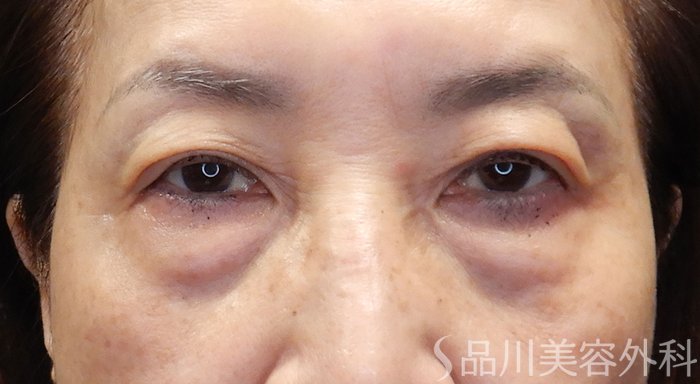 症例NO.71187のBEFORE写真