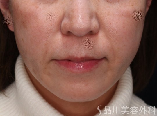 症例NO.72705のAFTER写真