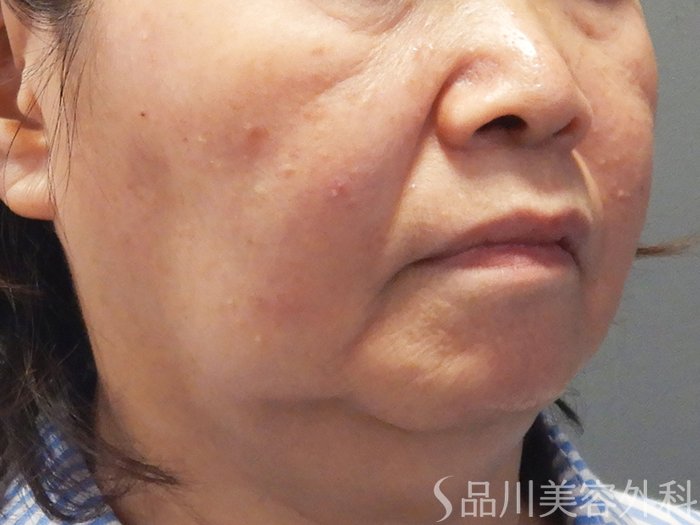 症例NO.72163のBEFORE写真