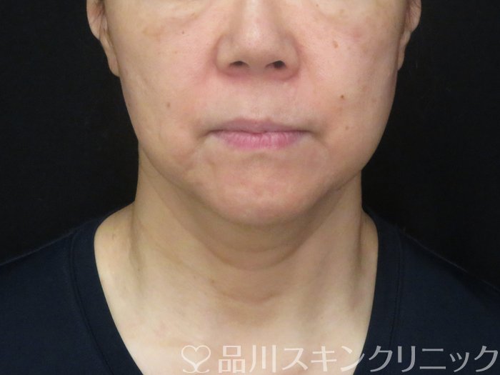 症例NO.69371のBEFORE写真