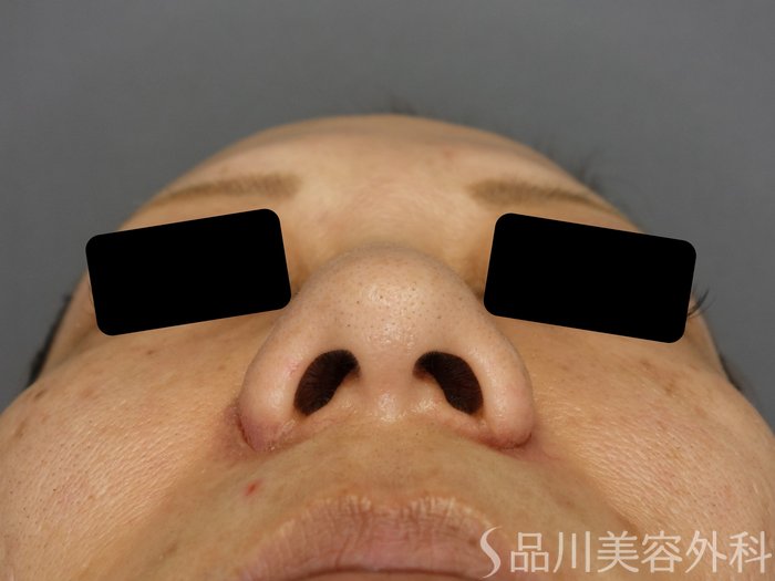 症例NO.74290のAFTER写真
