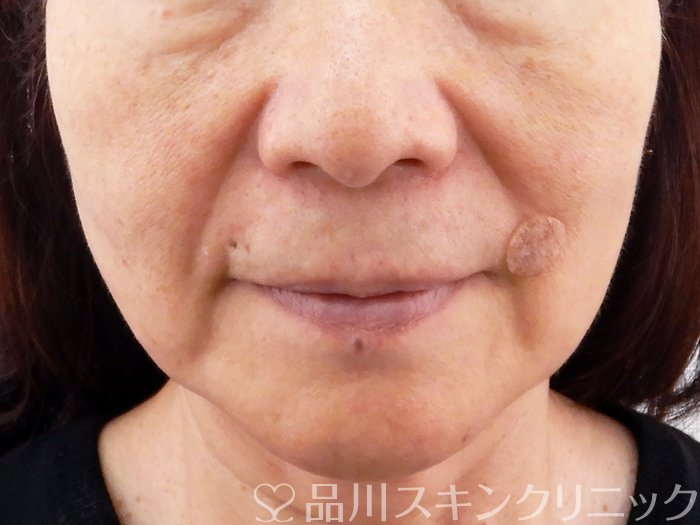 症例NO.62544のBEFORE写真