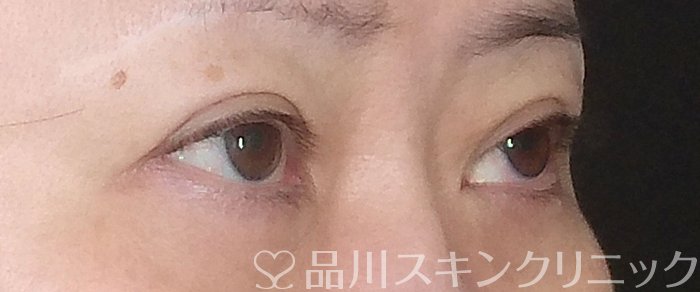 症例NO.68400のBEFORE写真