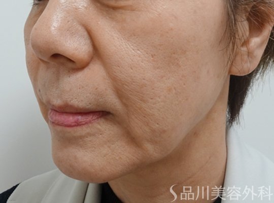 症例NO.71758のBEFORE写真