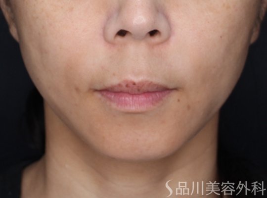 症例NO.71458のAFTER写真