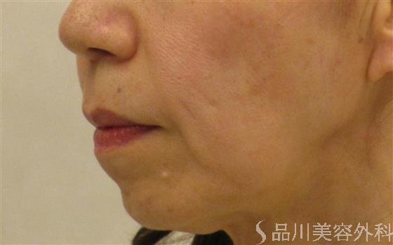 症例NO.57647のBEFORE写真