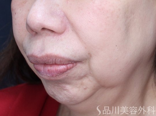 症例NO.73625のBEFORE写真