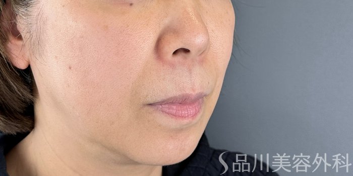 症例NO.69282のBEFORE写真
