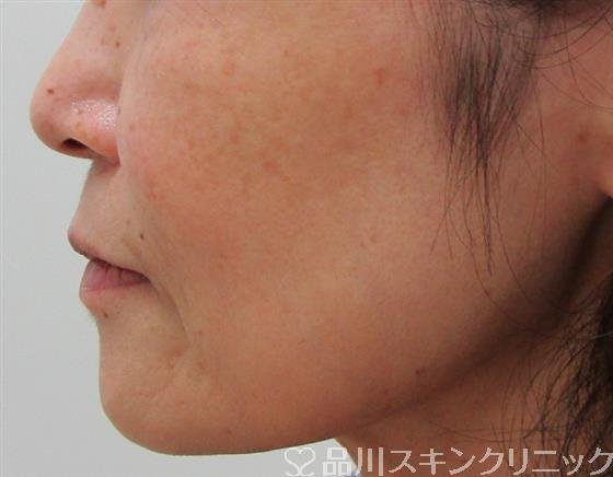 症例NO.30995のBEFORE写真