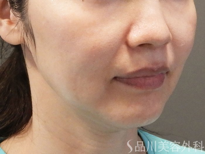 症例NO.69175のBEFORE写真