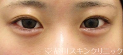 症例NO.65600のAFTER写真