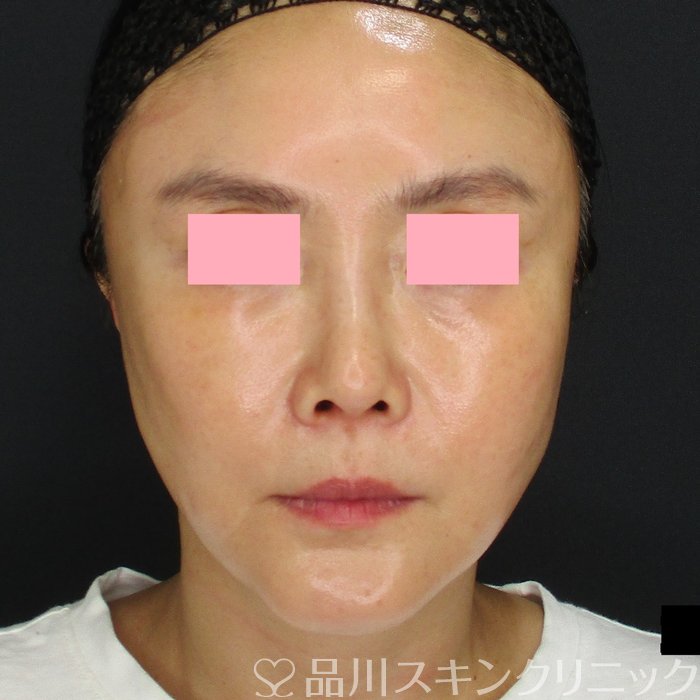 症例NO.74053のAFTER写真