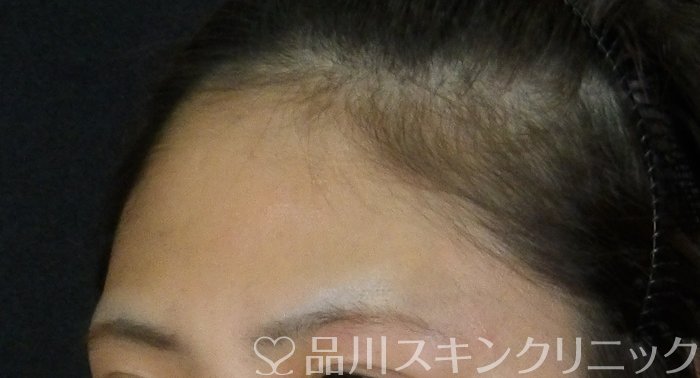 症例NO.72795のBEFORE写真