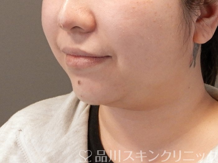 症例NO.64193のAFTER写真