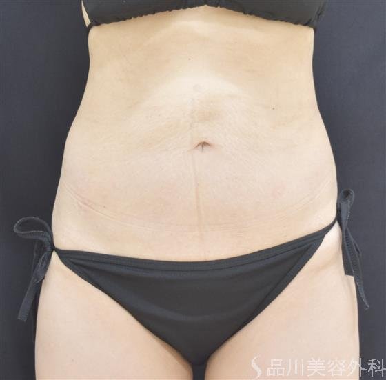 症例NO.45067のAFTER写真