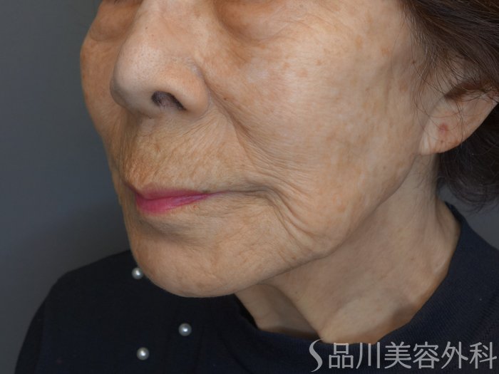 症例NO.74334のBEFORE写真
