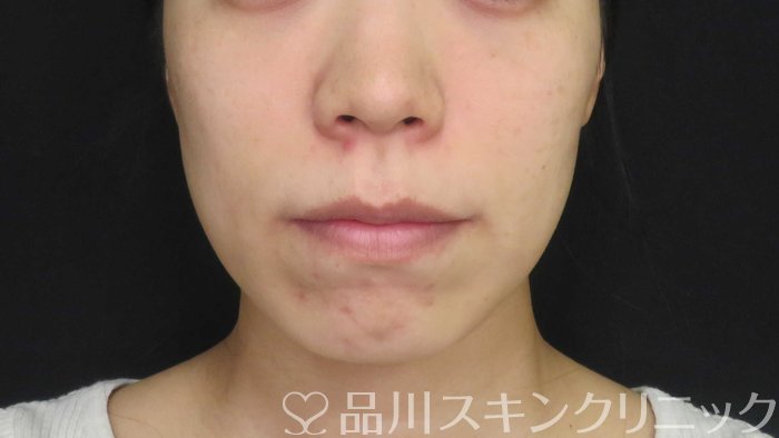 症例NO.72953のBEFORE写真