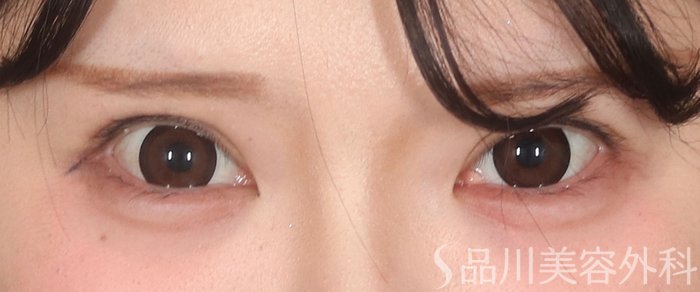 症例NO.73570のBEFORE写真