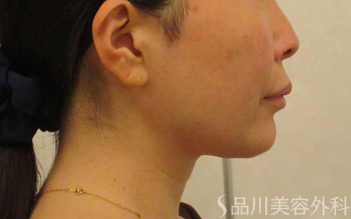 症例NO.71438のBEFORE写真