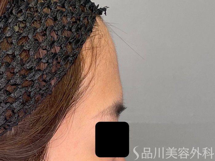 症例NO.70592のBEFORE写真
