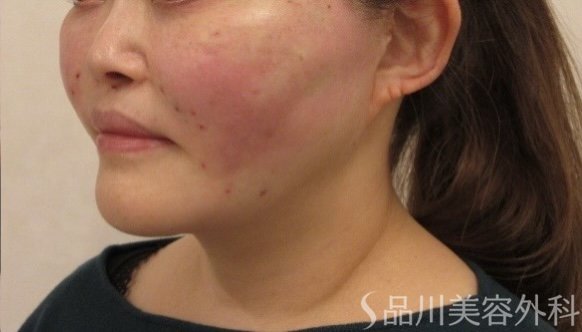 症例NO.75167のAFTER写真
