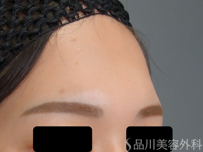症例NO.69736のBEFORE写真