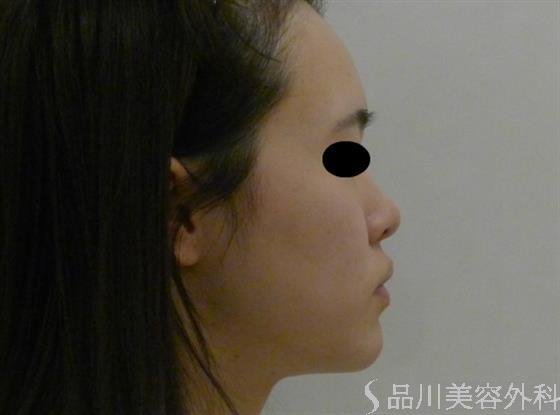 症例NO.39800のBEFORE写真