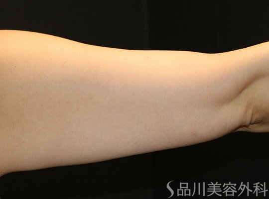 症例NO.74309のAFTER写真