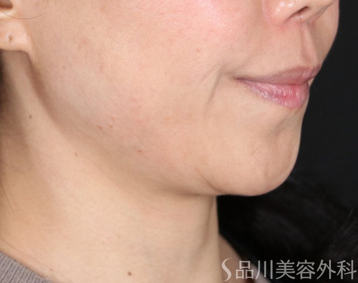 症例NO.72373のBEFORE写真