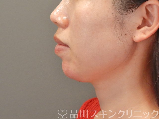 症例NO.75063のAFTER写真