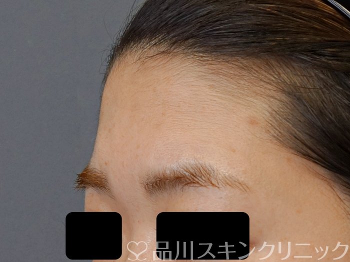 症例NO.72698のBEFORE写真