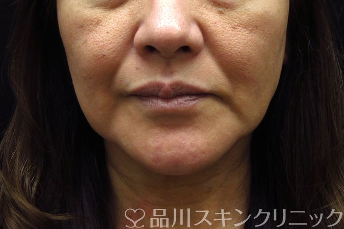 症例NO.74479のBEFORE写真