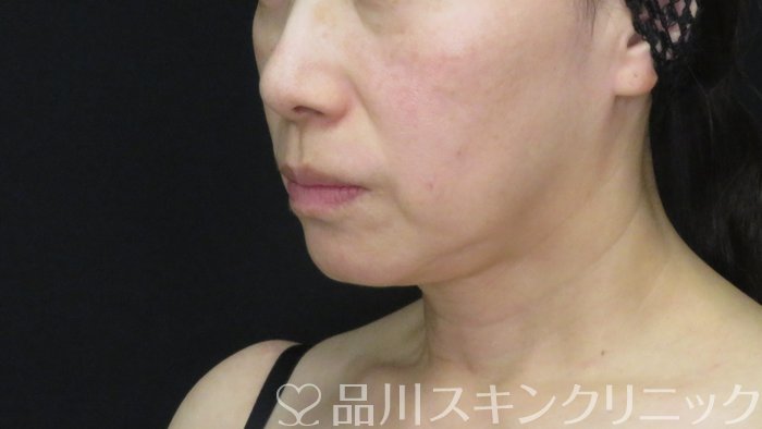 症例NO.72809のBEFORE写真