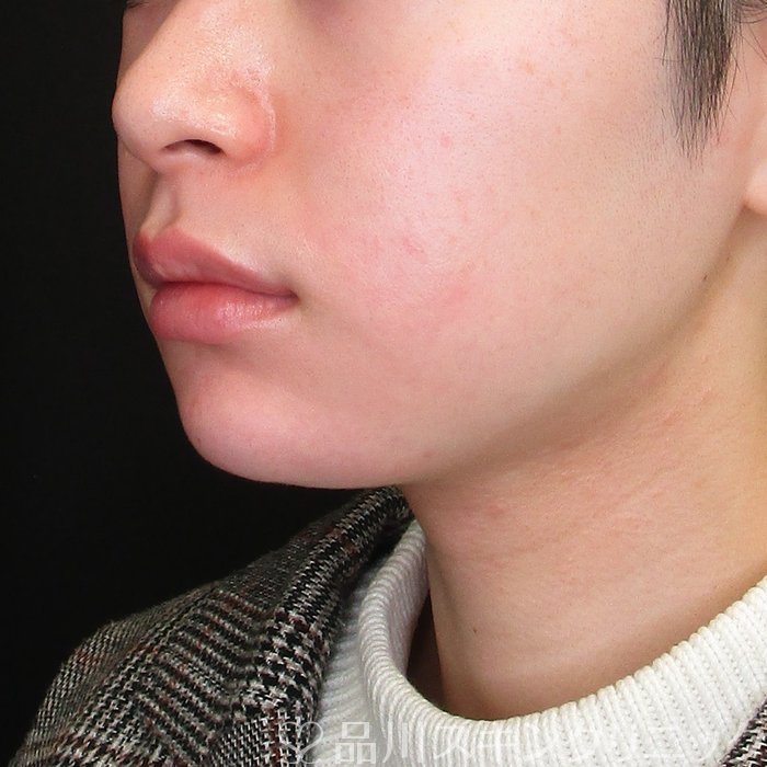 症例NO.72806のAFTER写真