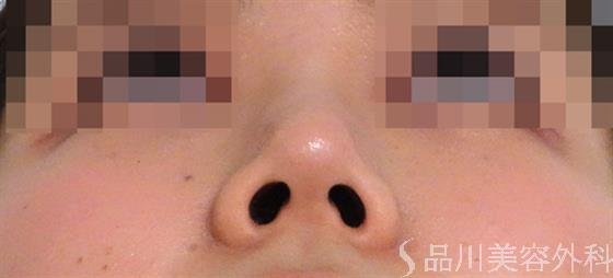 症例NO.36512のAFTER写真