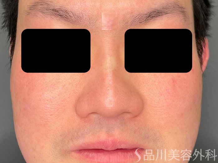 症例NO.74469のAFTER写真