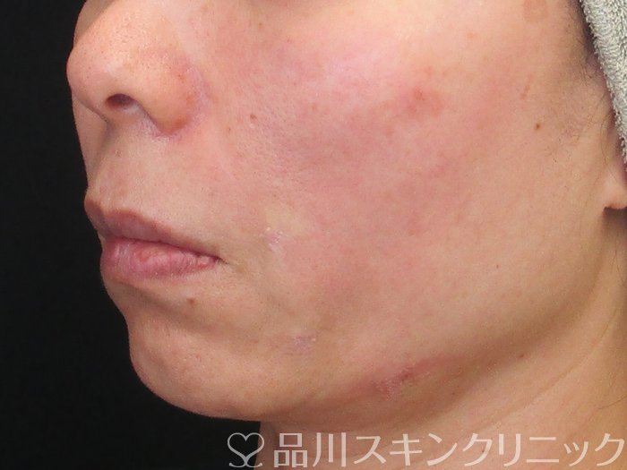 症例NO.72922のAFTER写真