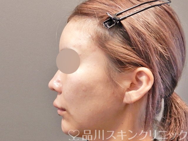 症例NO.67863のAFTER写真
