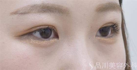 症例NO.46404のAFTER写真