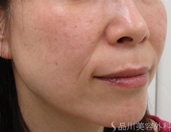 症例NO.44028のBEFORE写真