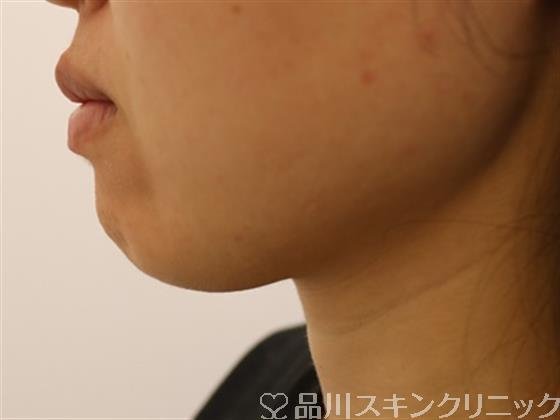 症例NO.40858のBEFORE写真