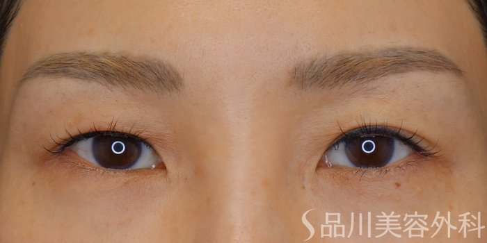 症例NO.72155のBEFORE写真