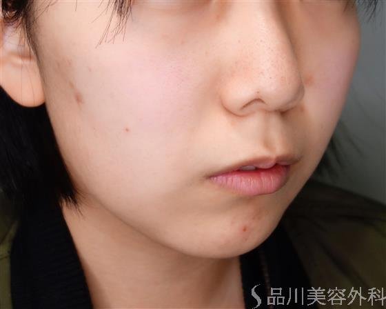 症例NO.50466のBEFORE写真