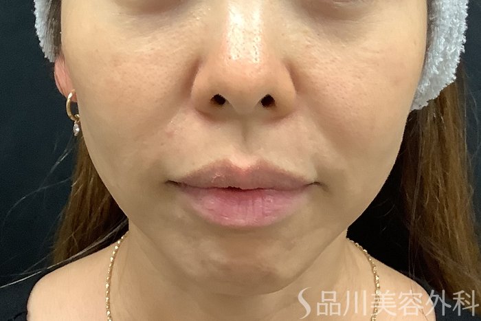 症例NO.71240のBEFORE写真