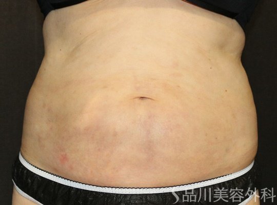 症例NO.73801のBEFORE写真