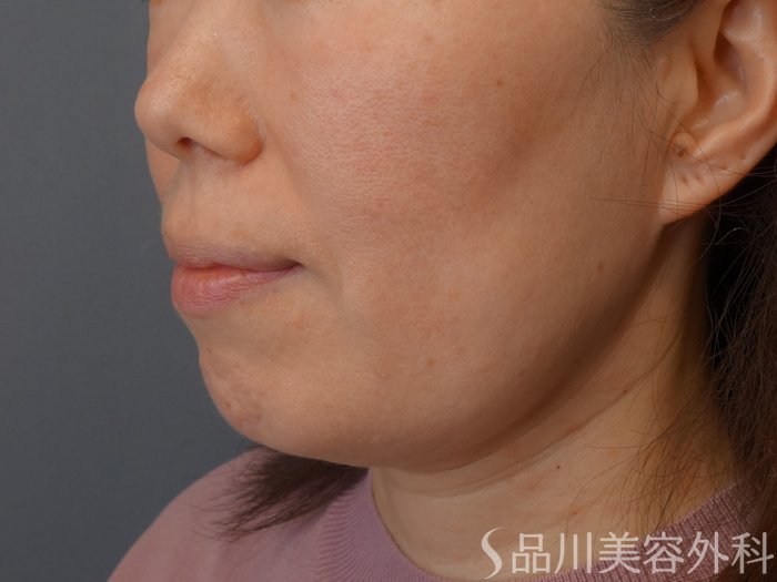 症例NO.74667のBEFORE写真